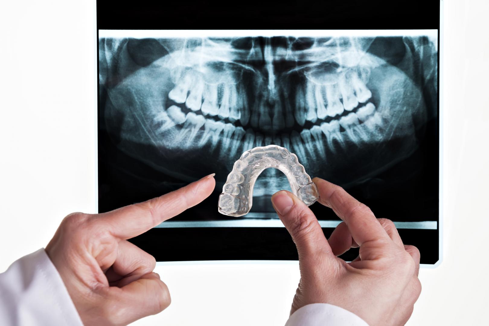 Root Canal Treatment Dandenong