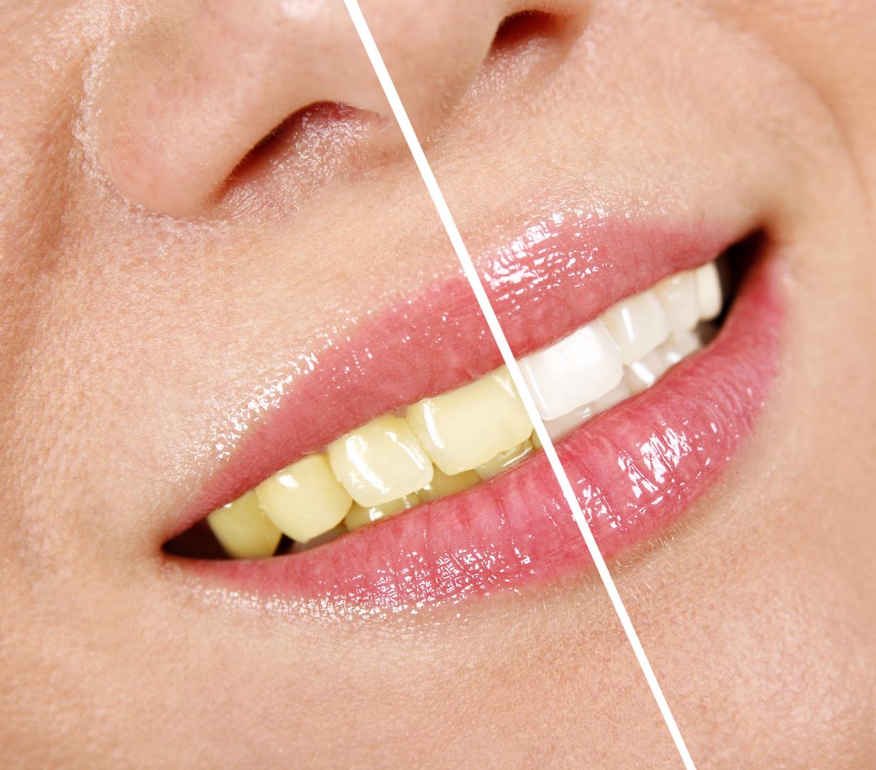 Teeth Cleaning & Whitening Dandenong